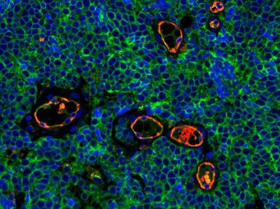 mmunofluorescent staining of Merkel cell carcinoma tumor tissue illustrating expression of CD200 (green) on the surface of tumor cells. CD200 plays a role in immunosuppression. The endothelial marker CD31 (red) highlights blood vessels. Merkel cell carcinoma is a rare and aggressive skin cancer.