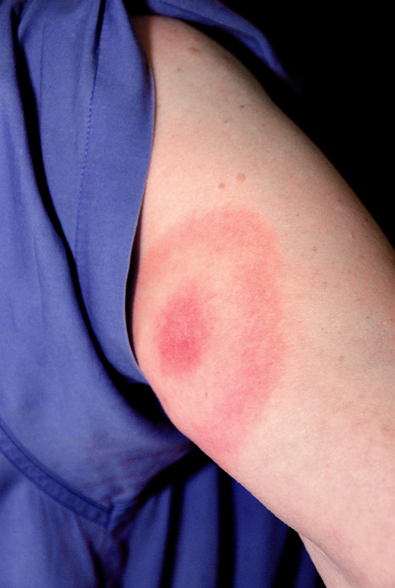 Tick Bites Are Sending More People Than Usual To The ER – Here’s What ...