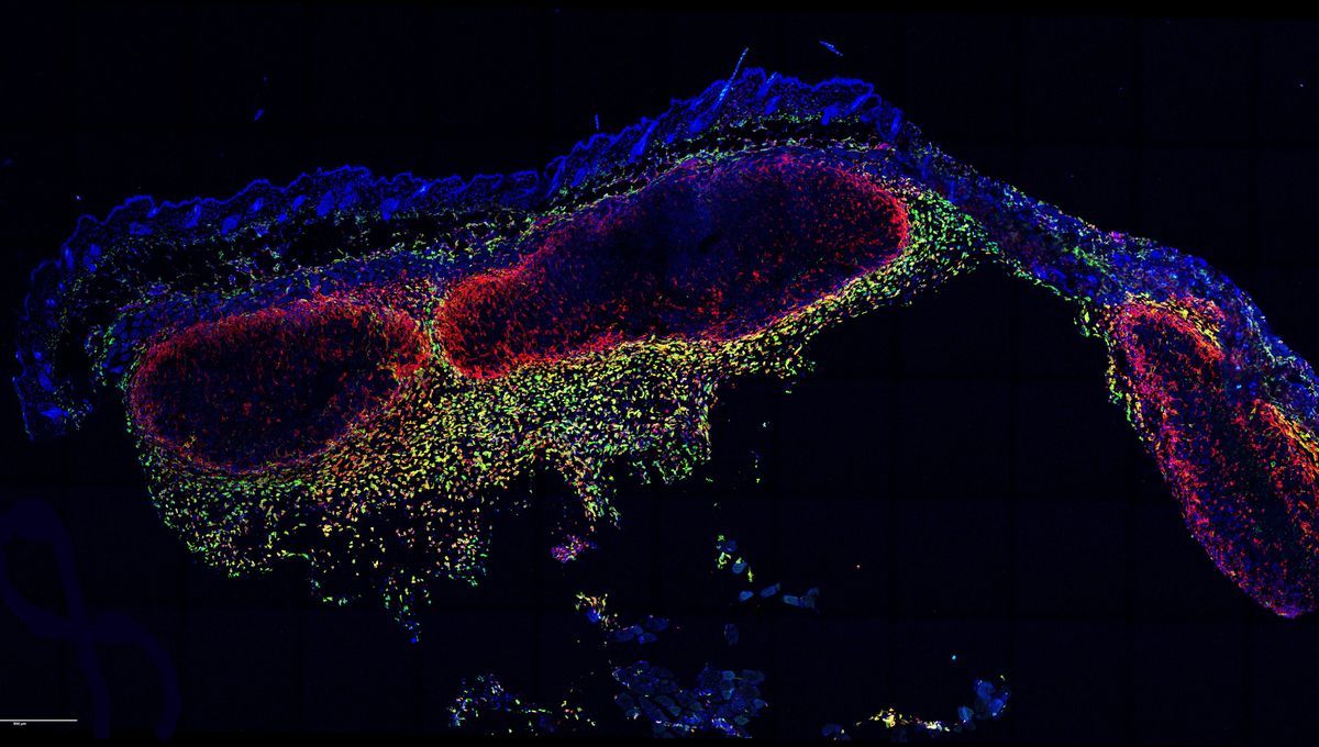 Watch Immune System “Housekeepers” Munching On Skin Cancer Cells In Incredible First-Of-Its-Kind Footage