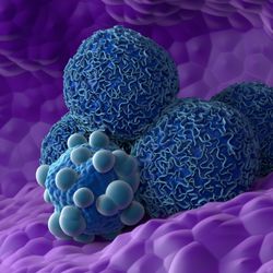 A digital image showing a cluster of cancer cells. They appear as four bulbous blue spheres with rough surfaces next to a smaller blue sphere with smaller lighter-blue blobs on it. This cluster is sitting in a deep purple terrain which is presumably the surface of the pancreas. 