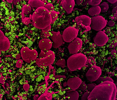 Colorized scanning electron micrograph of an apoptotic cell (pink) heavily infected with SARS-COV-2 virus particles (green), isolated from a patient sample.