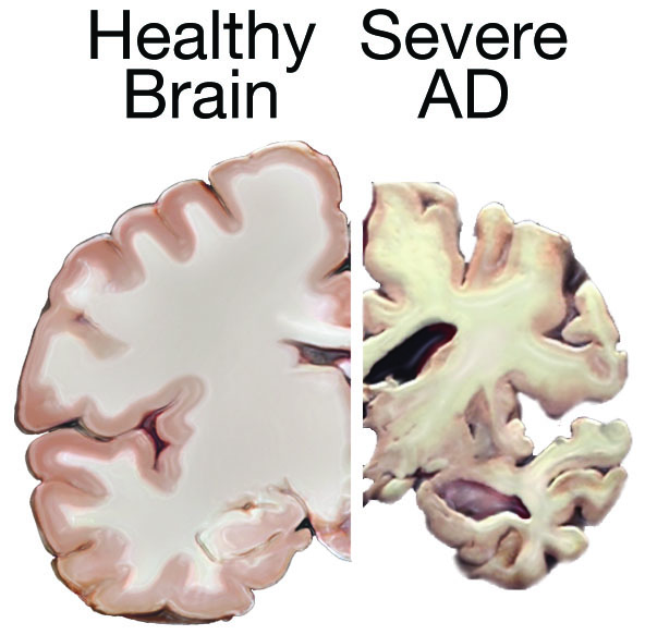 brain slices of a healthy brain (left) and brain with severe alzheimer's disease (right), showing the loss of brain tissue brain slices of a healthy brain (left) and brain with severe alzheimer's disease (right), showing the loss of brain tissue