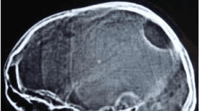 An X-ray of a skull affected by Gorham's disease. Bone is missing at the back of the cranium.
