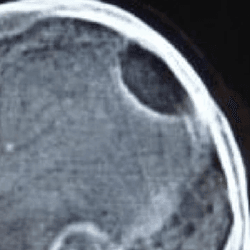 An X-ray of a skull affected by Gorham's disease. Bone is missing at the back of the cranium.