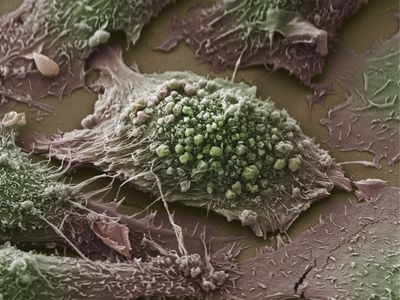 False colour scanning electron micrograph of a lung cancer cell grown in culture.