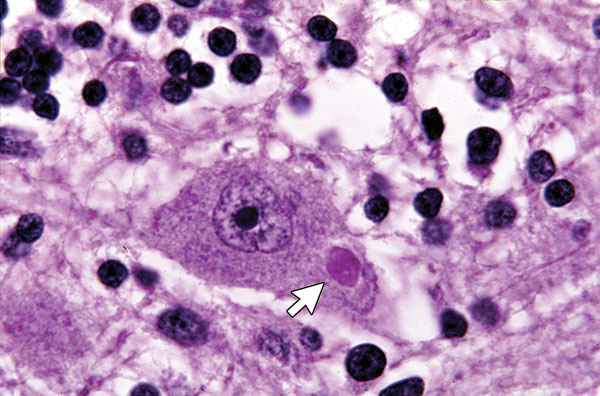 Neuron showing a cytoplasmic inclusion body (Negri body, arrow).