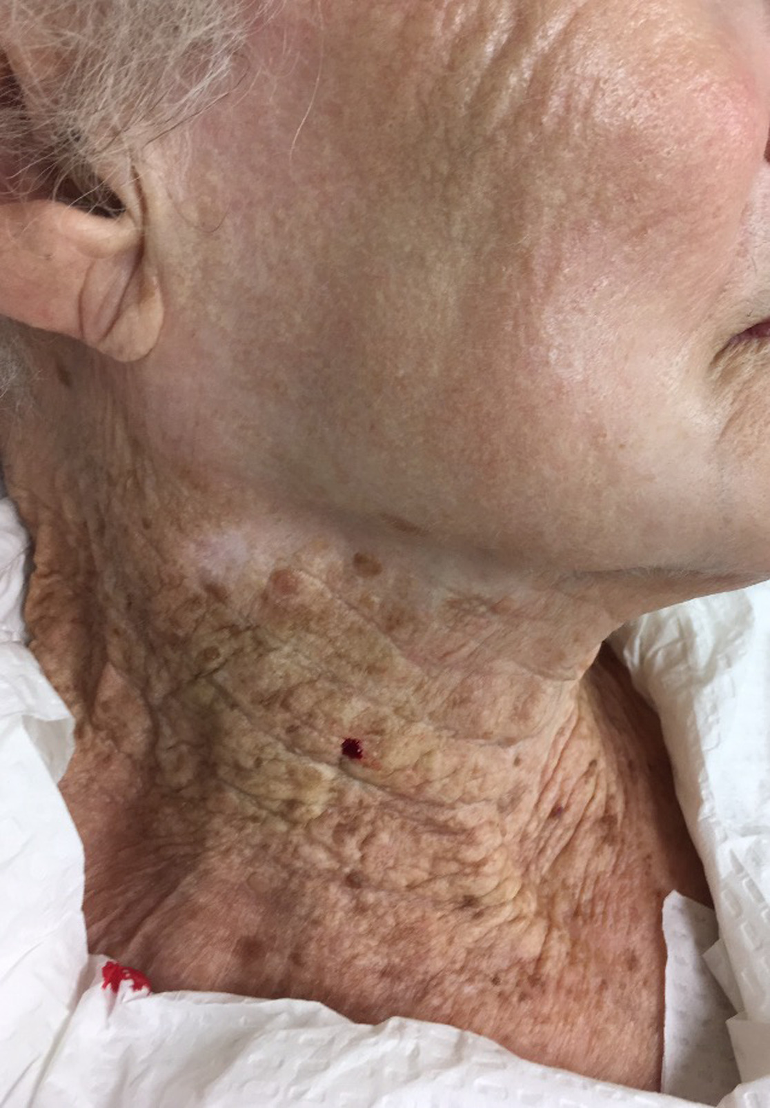 Cheek and neck of a 92-year-old female, who used UV-protective moisturizers on her face but not on the neck for 40+ years. 