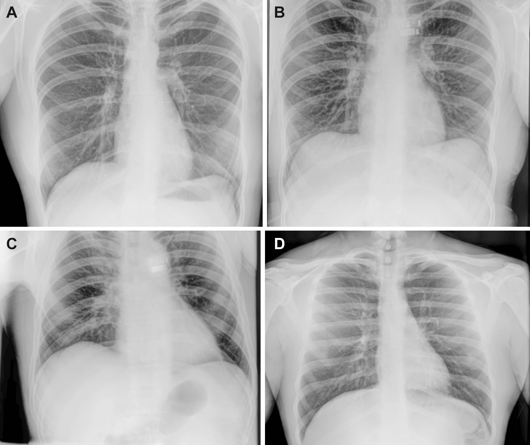 Chest X-rays look like more of a challenge, but B and C were taken in-flight, A by a crew-member preflight and D post-flight by a non-crew member using the same machine and methods