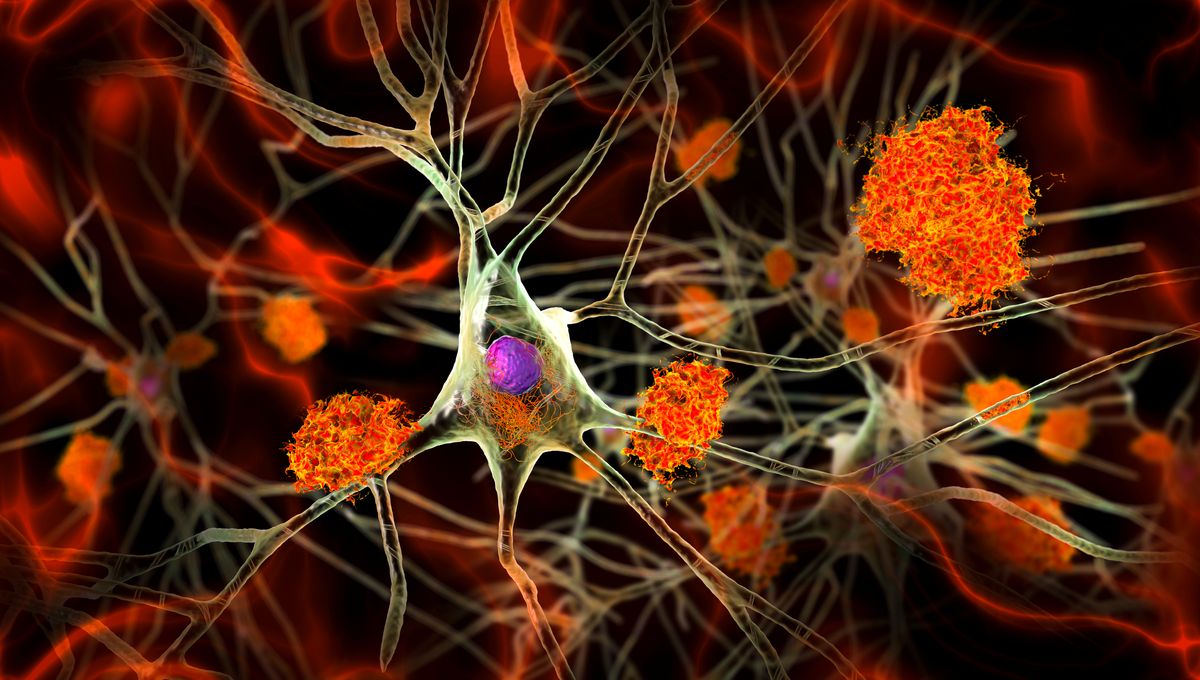 Brain Training That Really Works? First-Ever Clinical Proof That Science-Backed Exercises Can Reduce Levels Of Key Alzheimer’s Marker