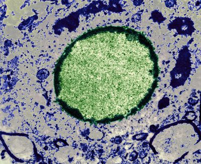 Measles infection in a brain cell nucleus.