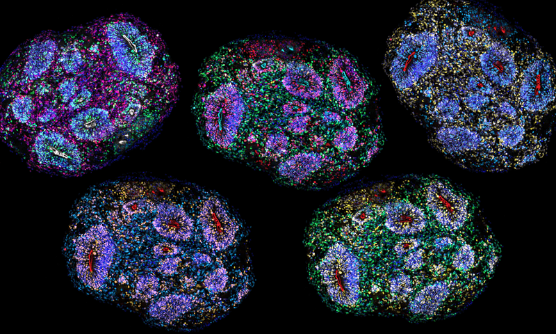 A composite mosaic of human brain organoids that have been immunolabelled for different cell type markers.