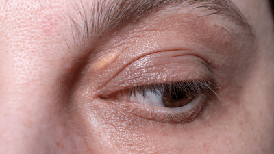 A xanthelasma on a man's eyelid; a slightly yellow lump under the skin.