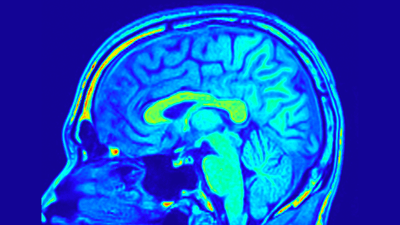 An MRI scan of a healthy brain.