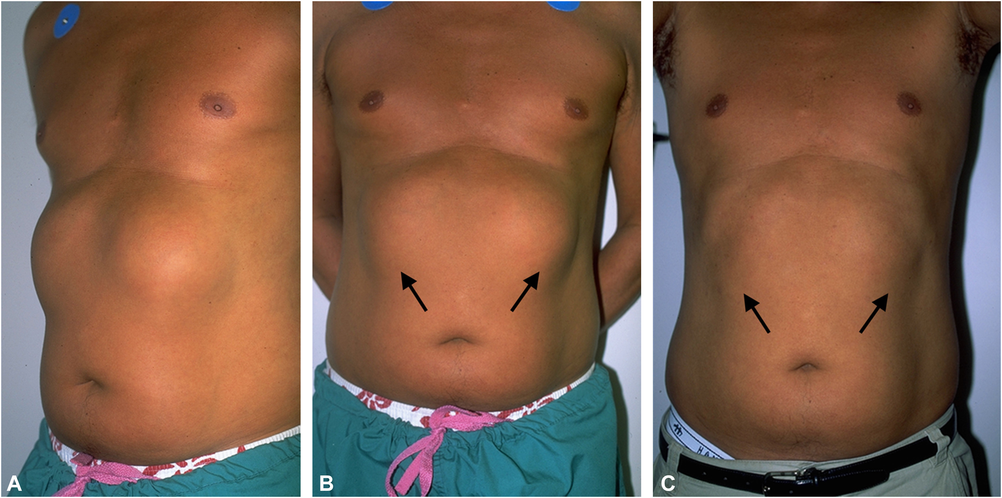 A 44-year-old man surfer presented with "remarkably prominent" grows on his chest (Images A and B). The patient's chet 12 months after second liposuction procedure (Image C). A 44-year-old man surfer presented with "remarkably prominent" grows on his chest (Images A and B). The patient's chet 12 months after second liposuction procedure (Image C).