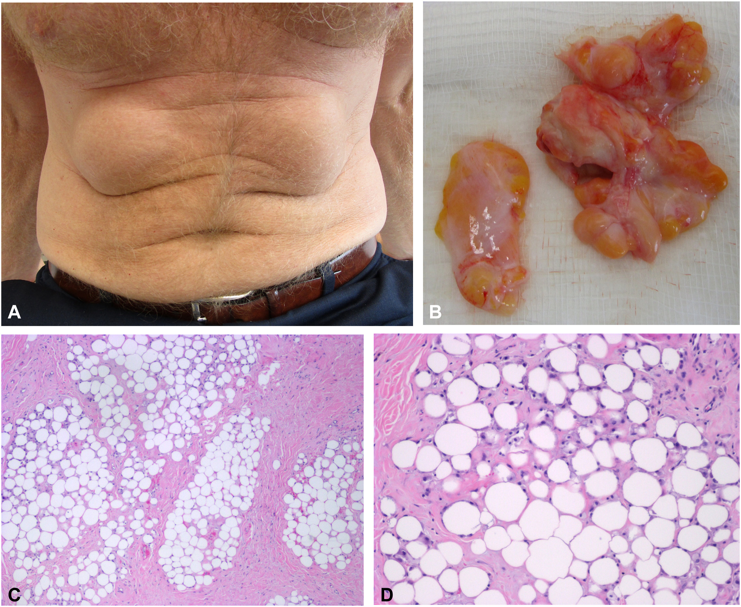 Liposurfomas on a 55-year-old male surfer (Image A), the fibrofatty mass after being removed (B), and photomicrographs of the tissue (C and D). Liposurfomas on a 55-year-old male surfer (Image A), the fibrofatty mass after being removed (B), and photomicrographs of the tissue (C and D).