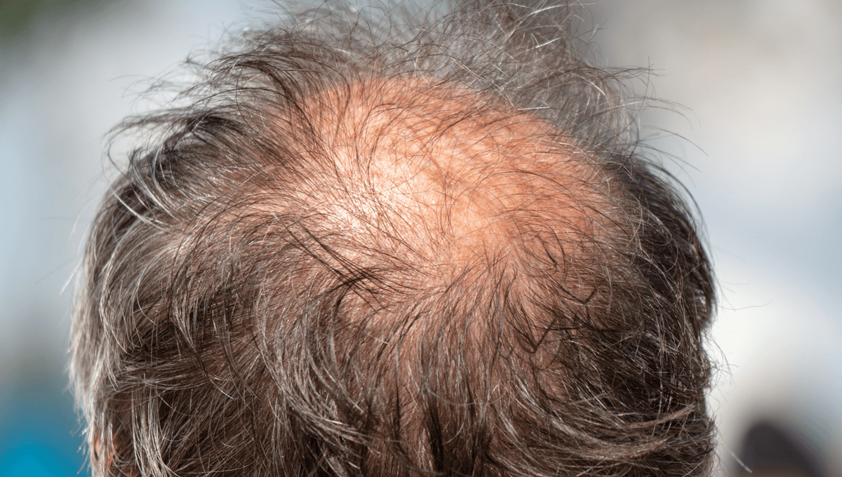 A New Hair Loss Pill Moves Closer To FDA Approval After A Positive Clinical Trial Involving Over 500 Balding Men